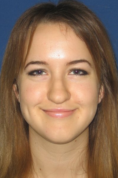 Rhinoplasty Before & After Image