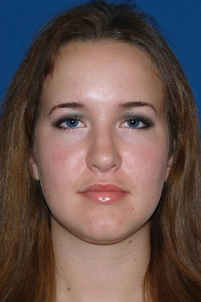 Rhinoplasty Before & After Image