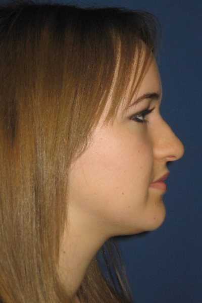 Rhinoplasty Before & After Image