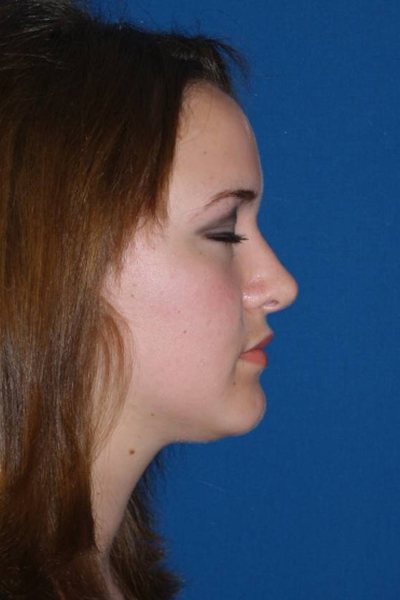 Rhinoplasty Before & After Image