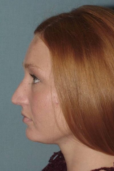 Rhinoplasty Before & After Image