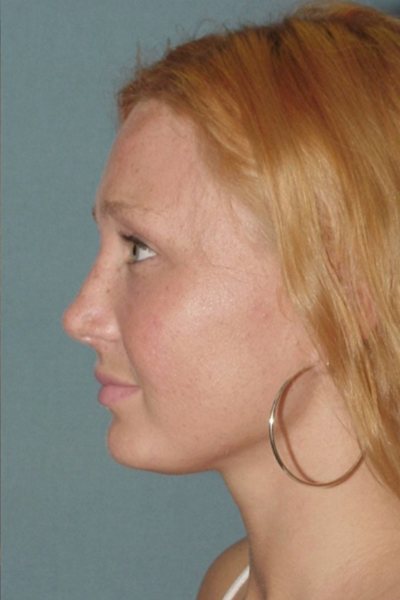 Rhinoplasty Before & After Image