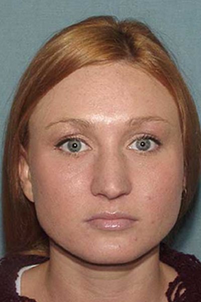 Rhinoplasty Before & After Image