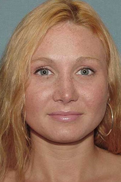 Rhinoplasty Before & After Image