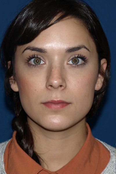 Rhinoplasty Before & After Image