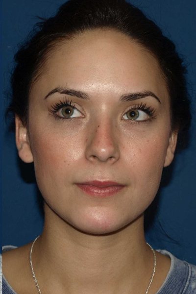 Rhinoplasty Before & After Image