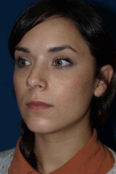 Rhinoplasty Before & After Image