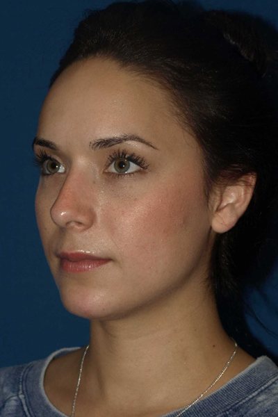 Rhinoplasty Before & After Image