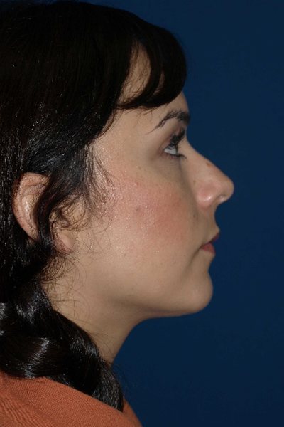 Rhinoplasty Before & After Image
