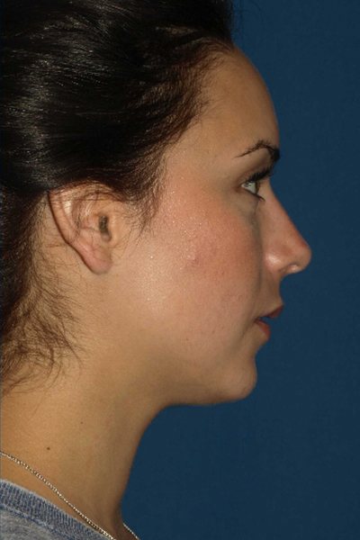 Rhinoplasty Before & After Image