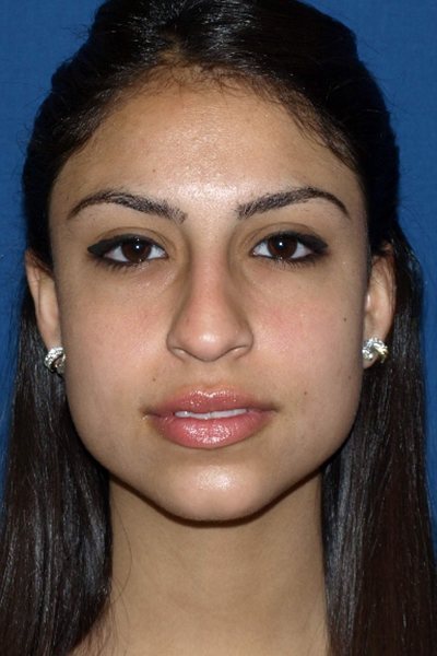 Rhinoplasty Before & After Image