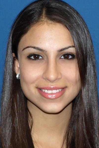 Rhinoplasty Before & After Image