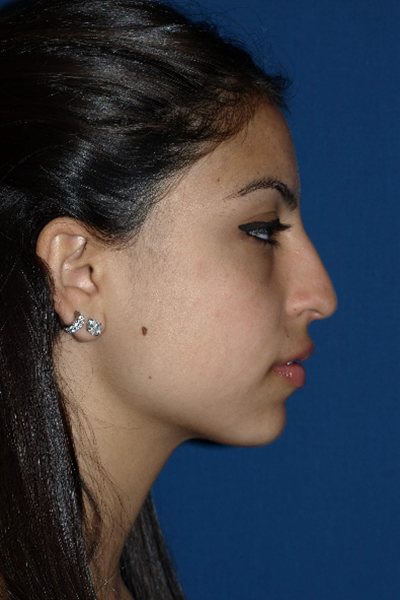 Rhinoplasty Before & After Image