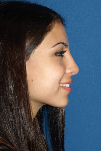 Rhinoplasty Before & After Image