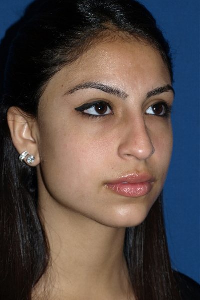 Rhinoplasty Before & After Image