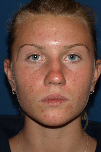 Rhinoplasty Before & After Image