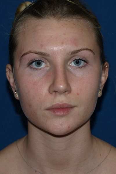 Rhinoplasty Before & After Image