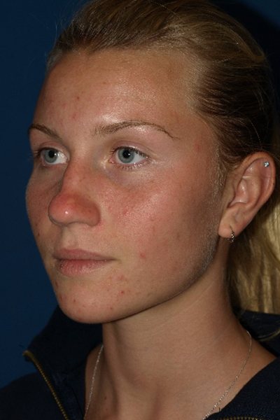 Rhinoplasty Before & After Image