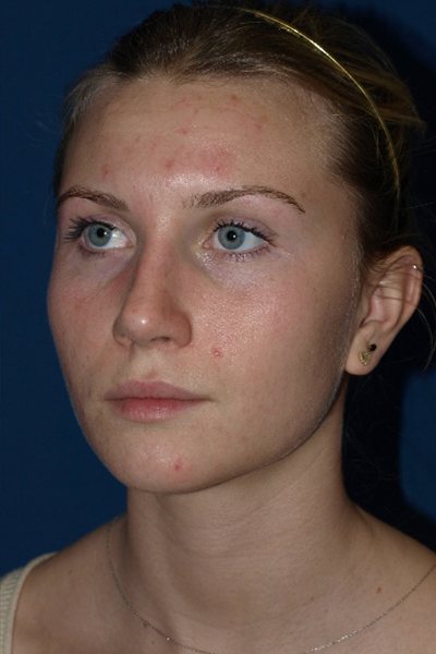 Rhinoplasty Before & After Image