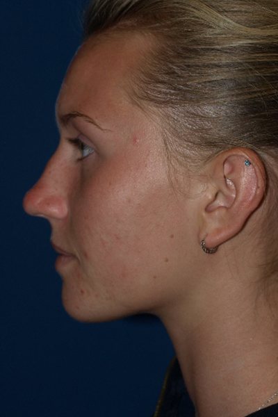Rhinoplasty Before & After Image