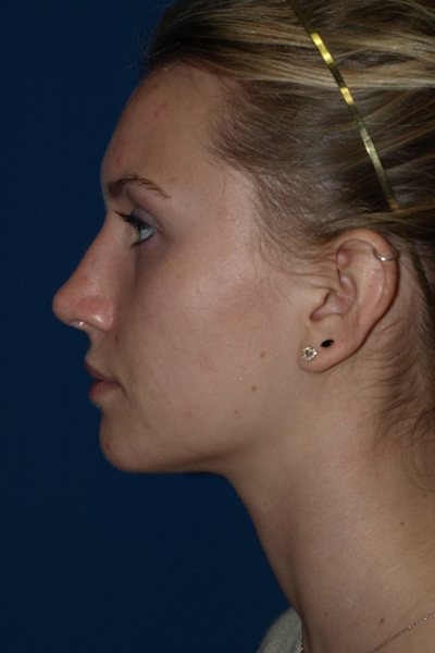 Rhinoplasty Before & After Image