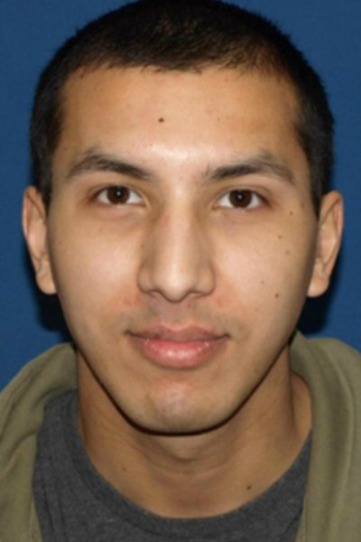 Rhinoplasty Before & After Image