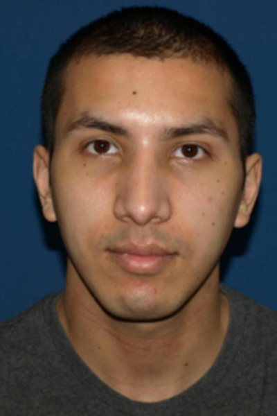 Rhinoplasty Before & After Image