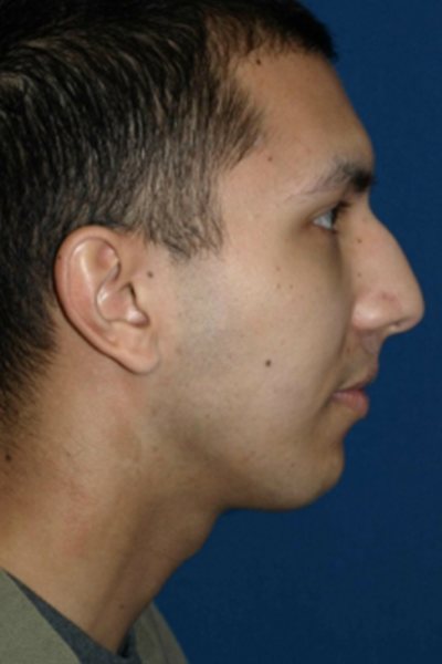 Rhinoplasty Before & After Image
