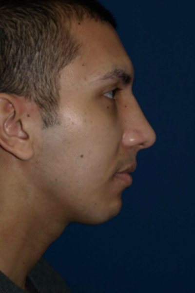 Rhinoplasty Before & After Image