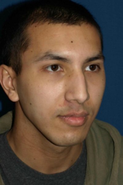 Rhinoplasty Before & After Image