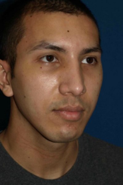 Rhinoplasty Before & After Image