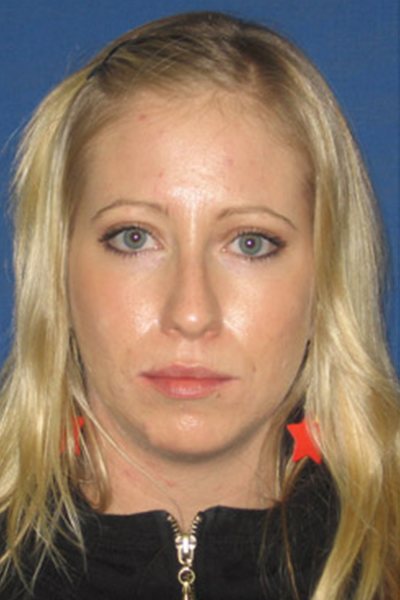 Rhinoplasty Before & After Image