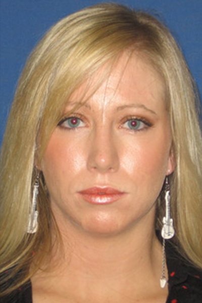 Rhinoplasty Before & After Image