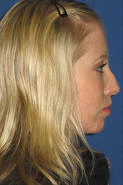 Rhinoplasty Before & After Image