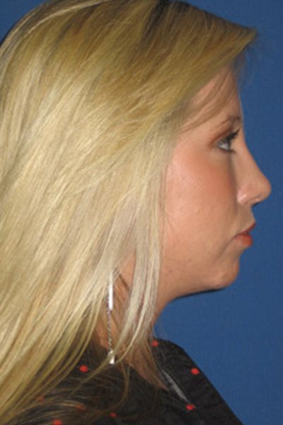 Rhinoplasty Before & After Image