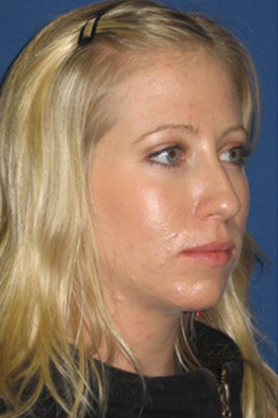 Rhinoplasty Before & After Image
