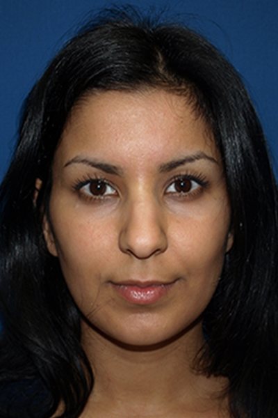 Rhinoplasty Before & After Image