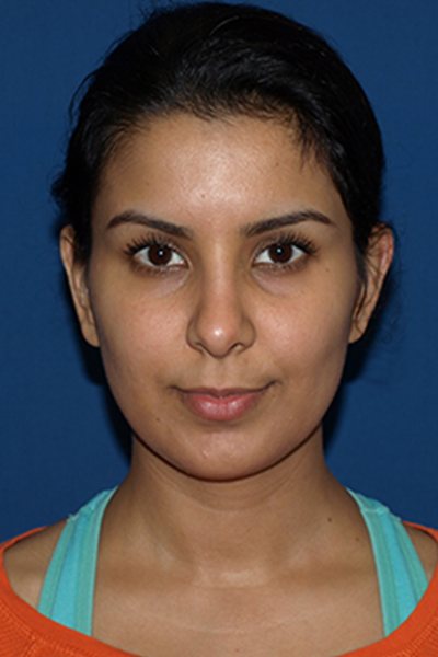 Rhinoplasty Before & After Image