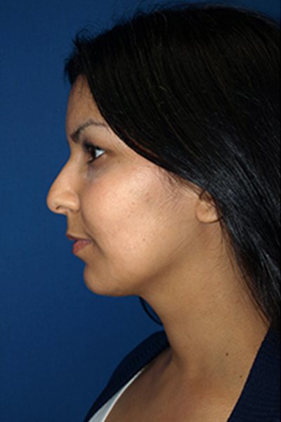 Rhinoplasty Before & After Image