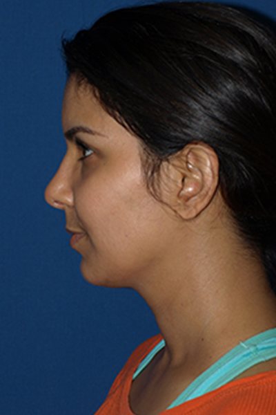 Rhinoplasty Before & After Image