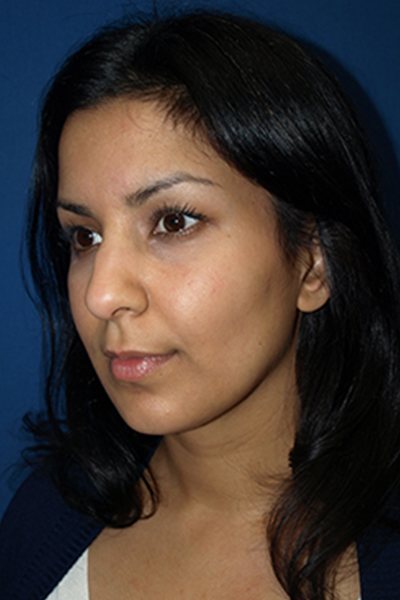 Rhinoplasty Before & After Image