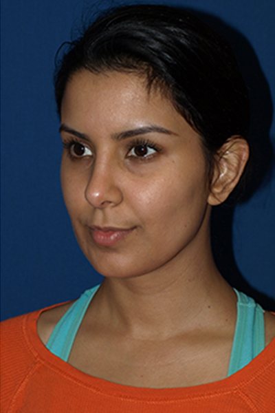 Rhinoplasty Before & After Image