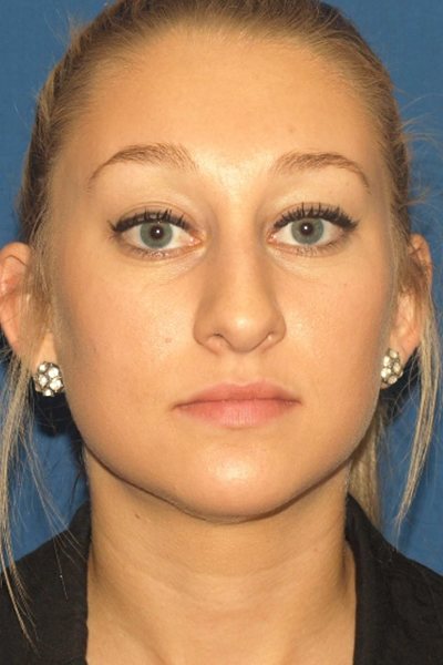 Rhinoplasty Before & After Image