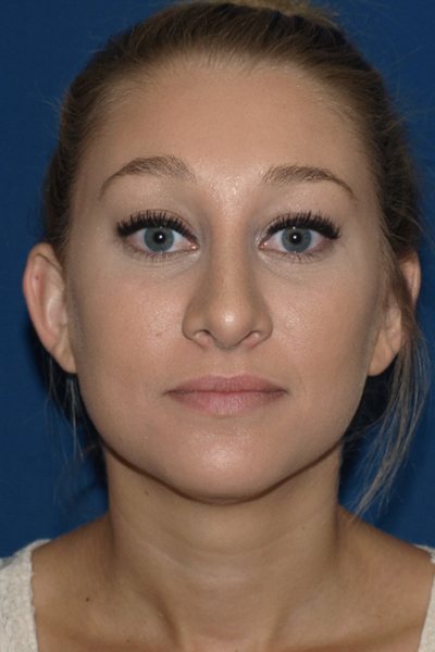 Rhinoplasty Before & After Image