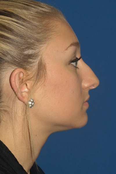 Rhinoplasty Before & After Image