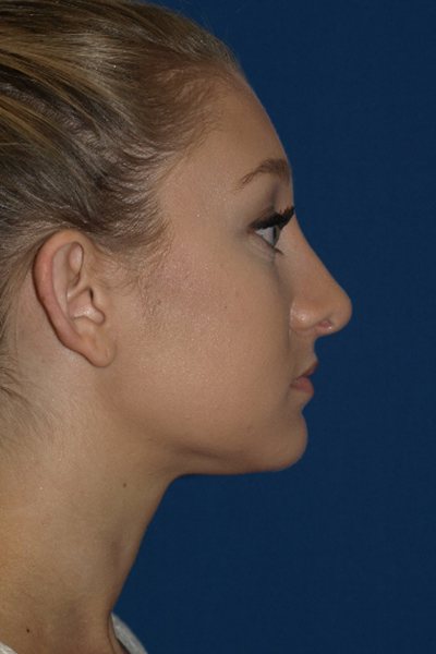 Rhinoplasty Before & After Image