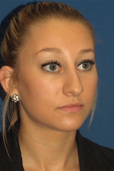 Rhinoplasty Before & After Image