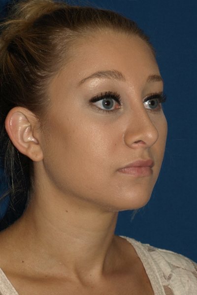 Rhinoplasty Before & After Image