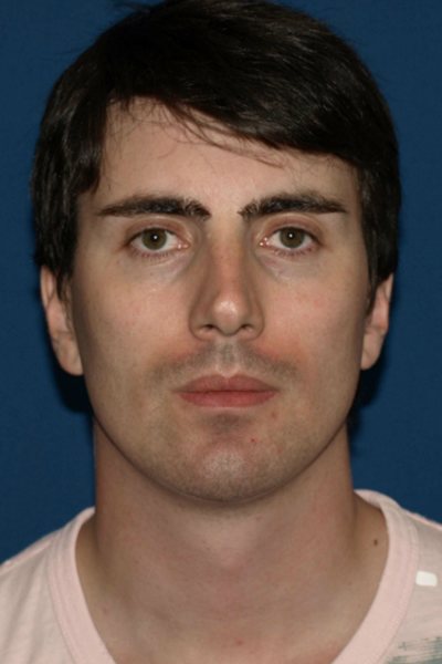 Rhinoplasty Before & After Image