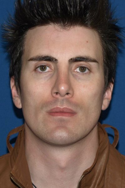 Rhinoplasty Before & After Image